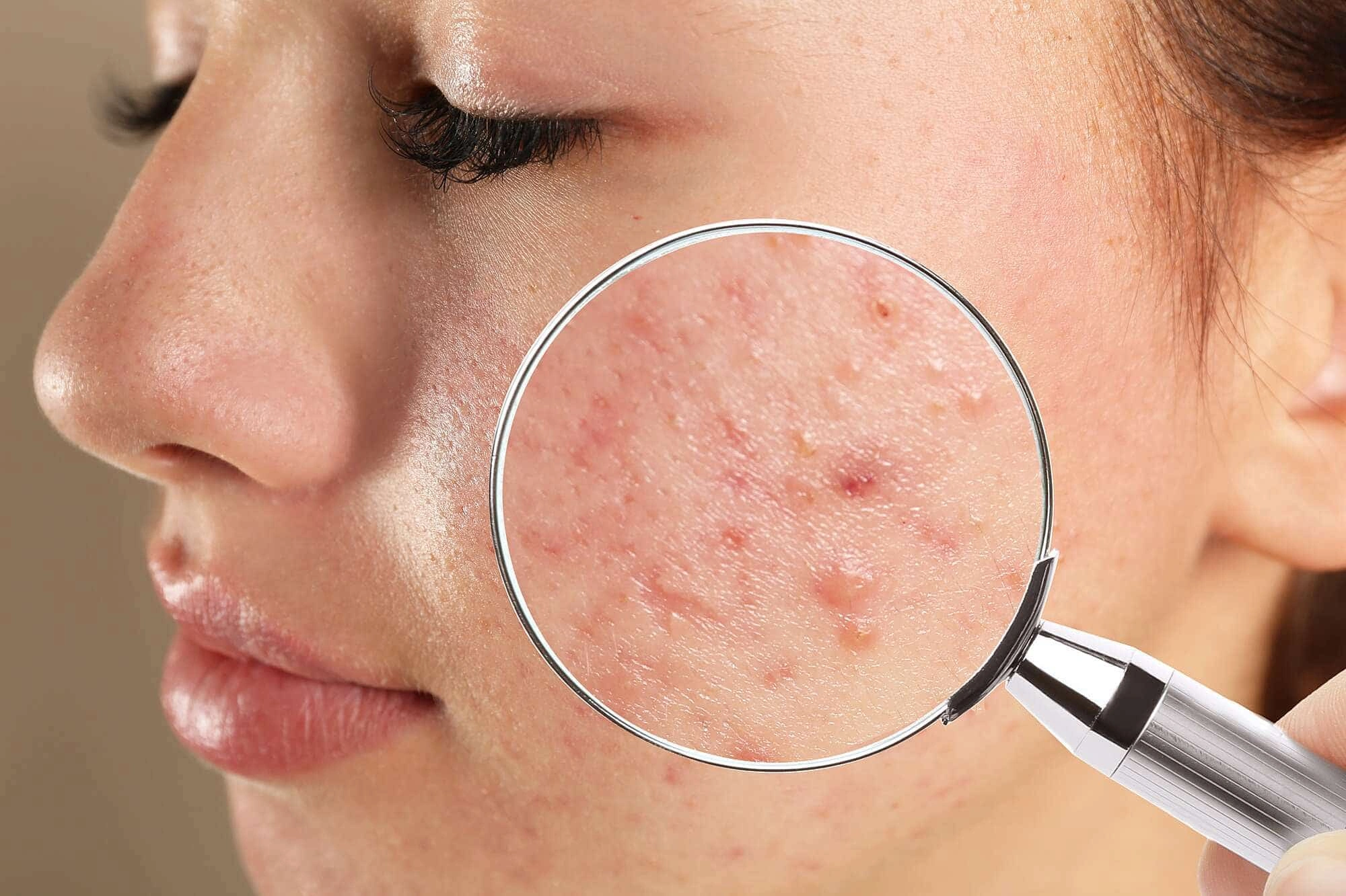 ACNE treatment - Natural Treatment at Deepak Nature Cure