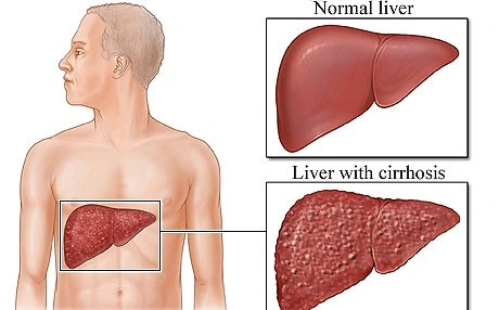 Cirrhosis of liver - Natural Treatment at Deepak Nature Cure