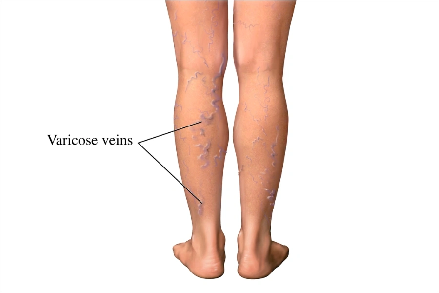 Varicose Veins - Natural Treatment at Deepak Nature Cure