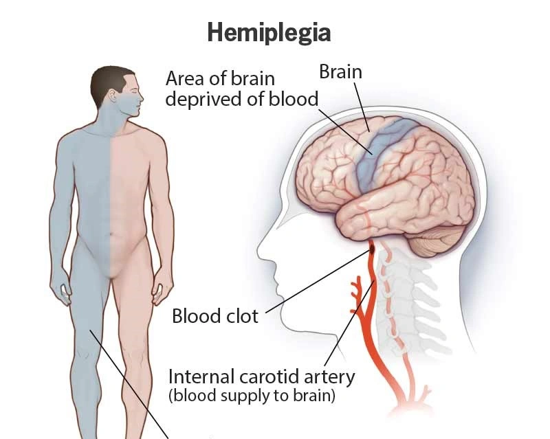 Monoplegia - Natural Treatment at Deepak Nature Cure