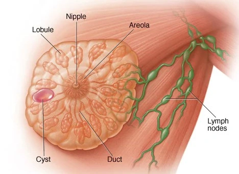 Breast cysts - Natural Treatment at Deepak Nature Cure