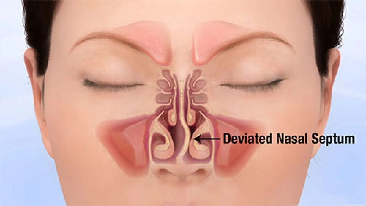 Septum Deviation Nose - Natural Treatment at Deepak Nature Cure