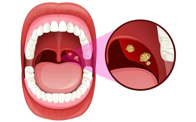 Tonsillitis - Natural Treatment at Deepak Nature Cure