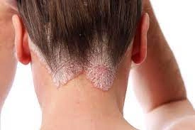 Psoriasis - Natural Treatment at Deepak Nature Cure