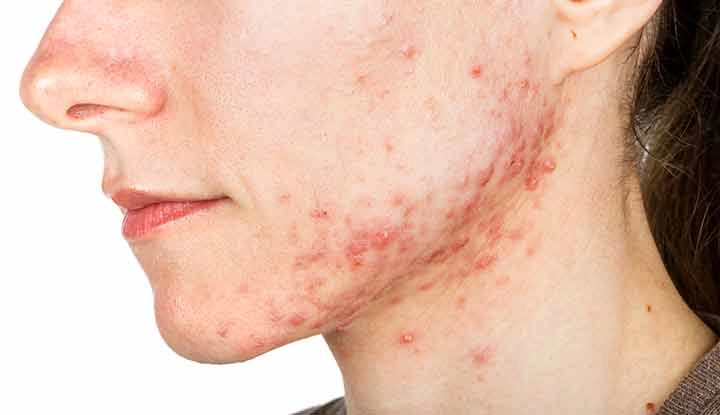 ACNE/ Pimple - Natural Treatment at Deepak Nature Cure