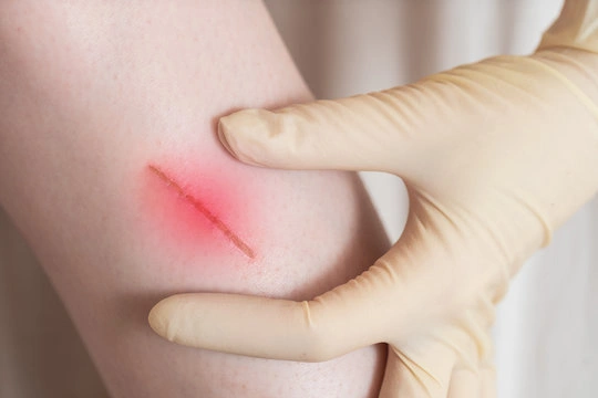 NON Healing wounds - Natural Treatment at Deepak Nature Cure